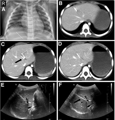 Case report and literature review: An intrahepatic sewing needle in a child